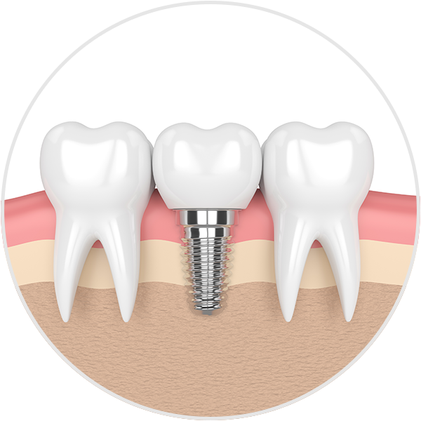 dental-implant-illust-circle